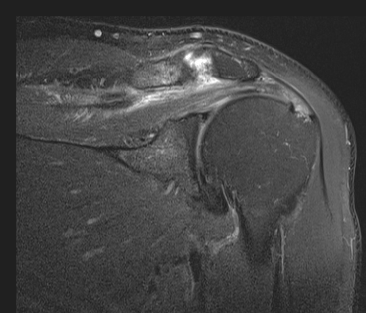 Figure 3 for case Massive interstitial delamination of Supraspinatus with retraction